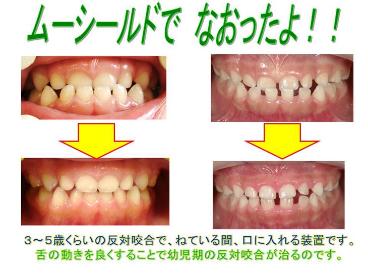 ムーシールド (小児矯正) - その他