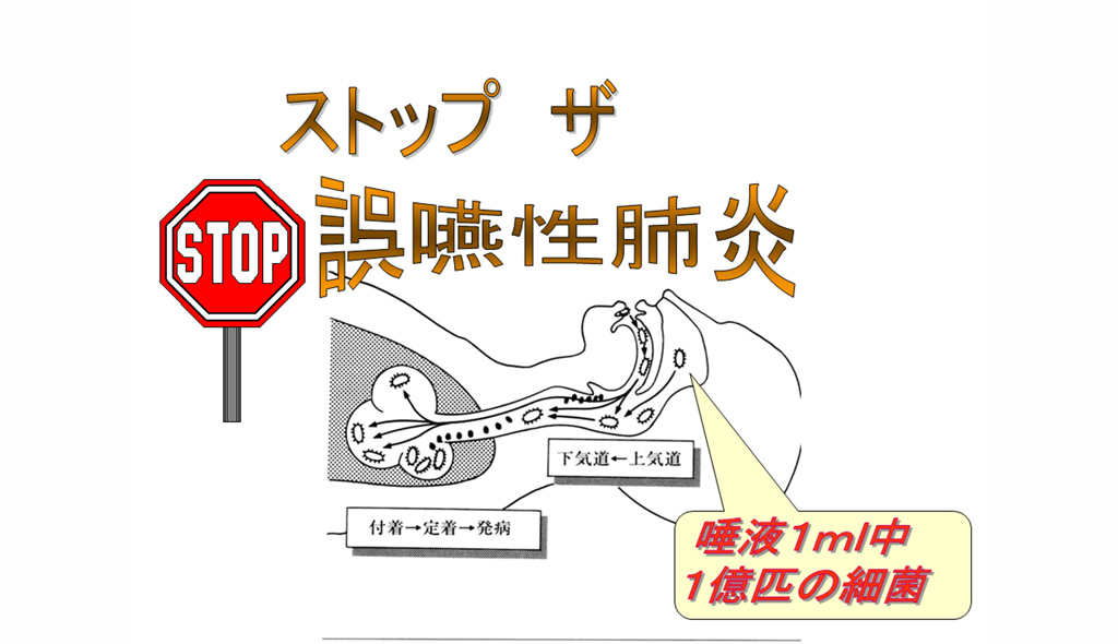 「STOP 誤嚥性肺炎」唾液1ml中に一億匹の細菌。口腔内の細菌が上気道から下気道に侵入。肺に付着、定着することで発症。