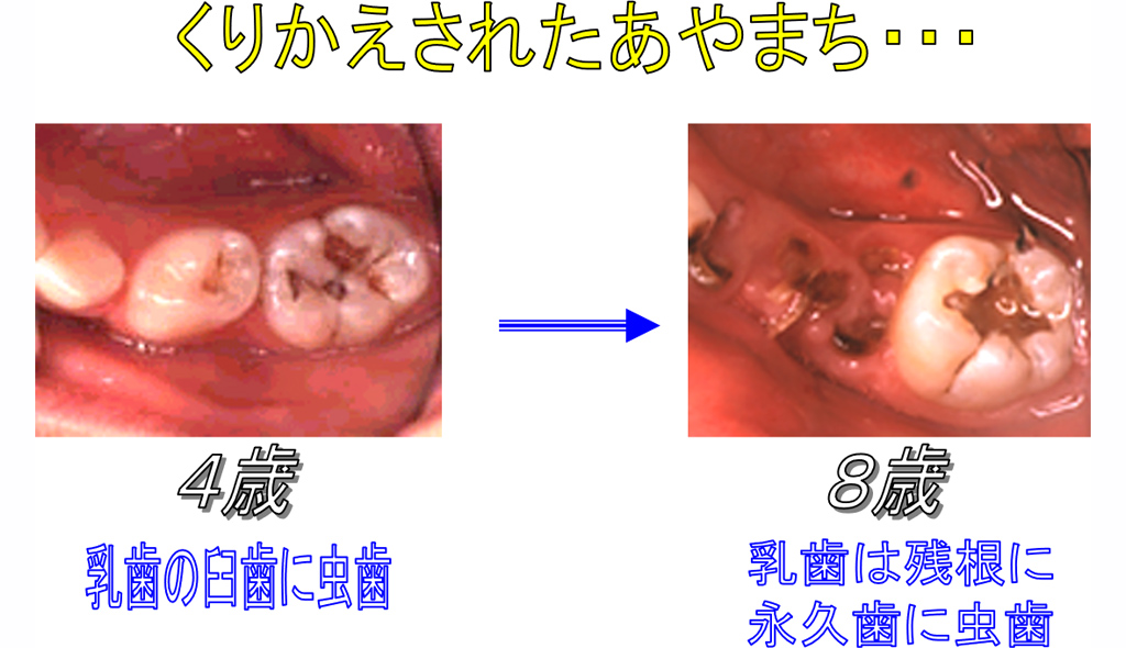 「くりかえされたあやまち&hellip;」4歳：乳歯の臼歯に虫歯&rarr;8歳：乳歯は残根に。永久歯に虫歯